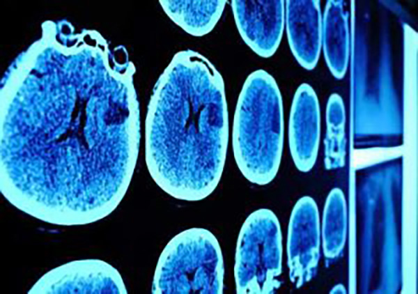 Parkinson's Disease Pathway