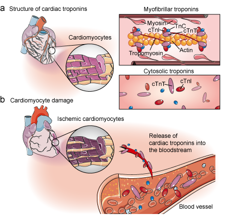 Cardiac troponins and cardiomyocyte damage