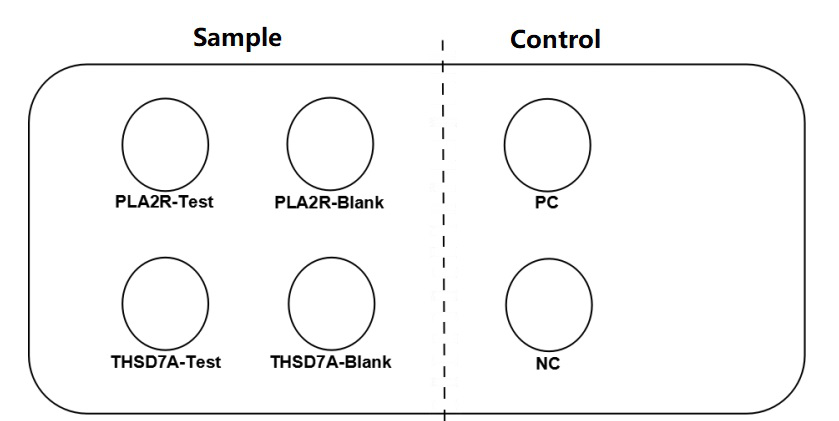 Phospholipase A2 receptor (PLA2R) and THSD7A stable cell line